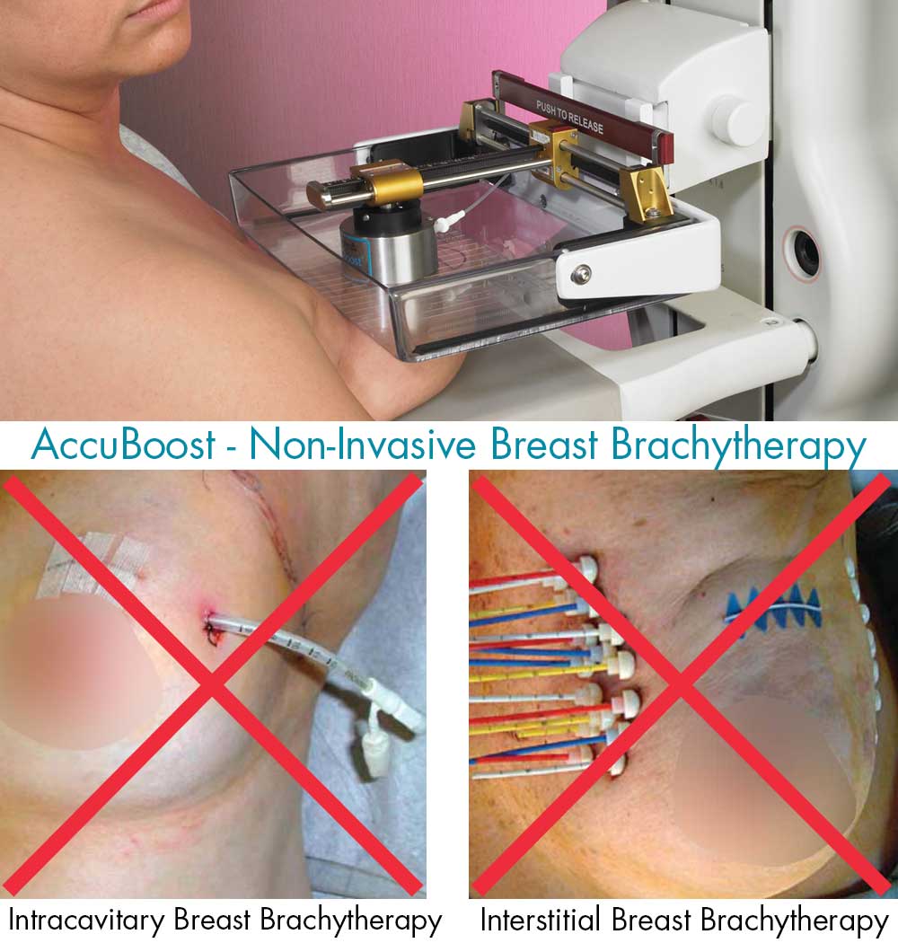 Breast Brachytherapy for APBI - Accelerated Partial Breast Irradiation